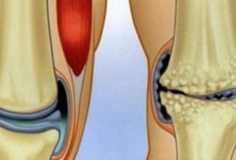 cum să tratezi picioarele cu artroza piciorului artroza de gradul I cum se tratează