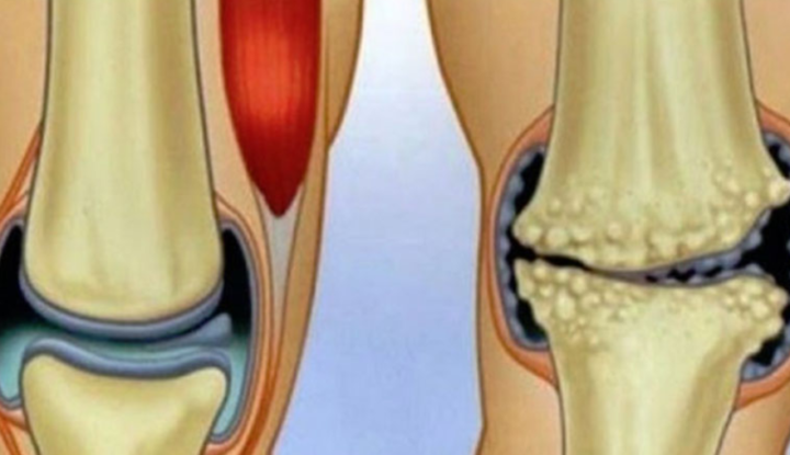 remediu articular ieftin)